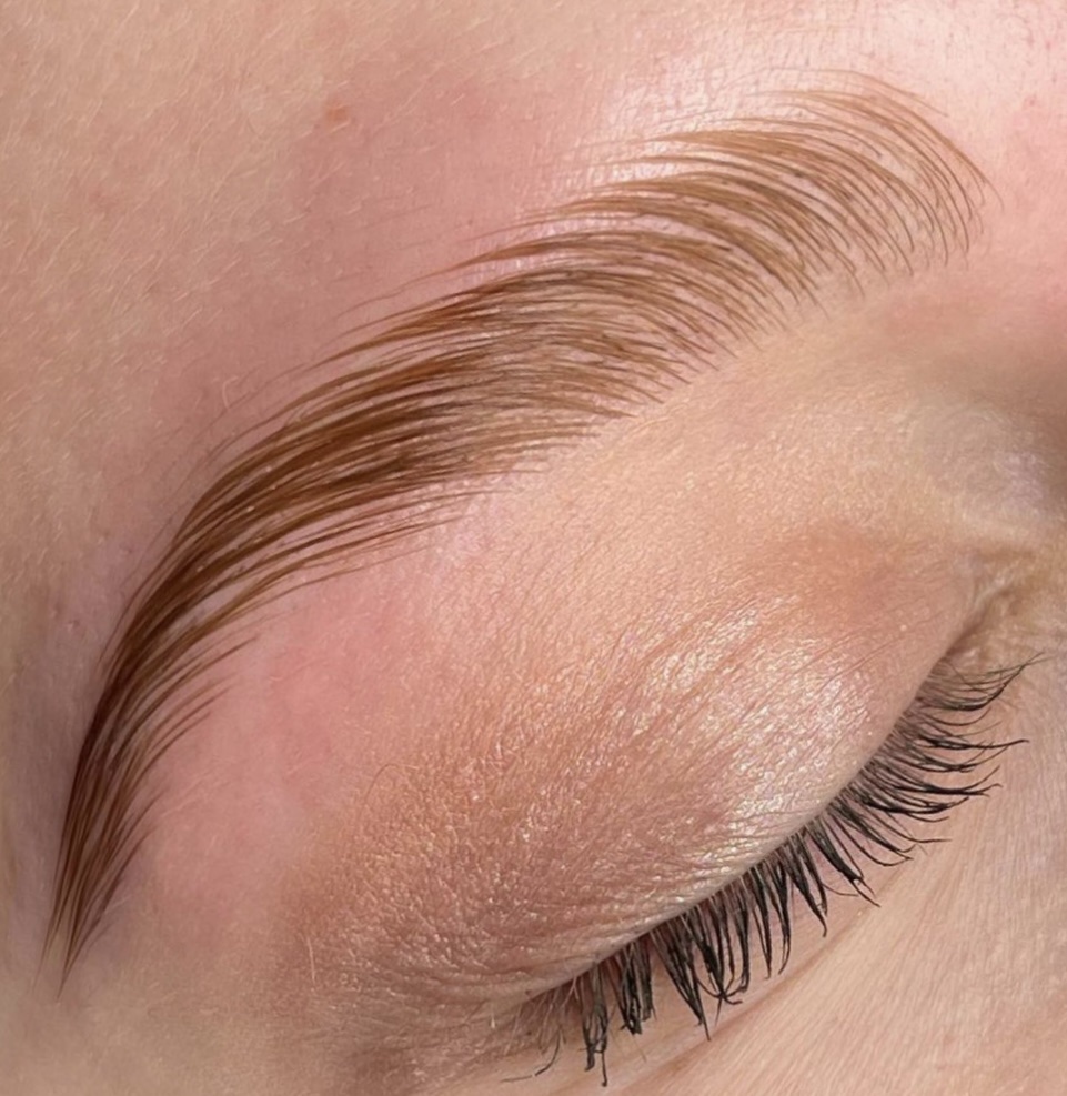 Brow Lift