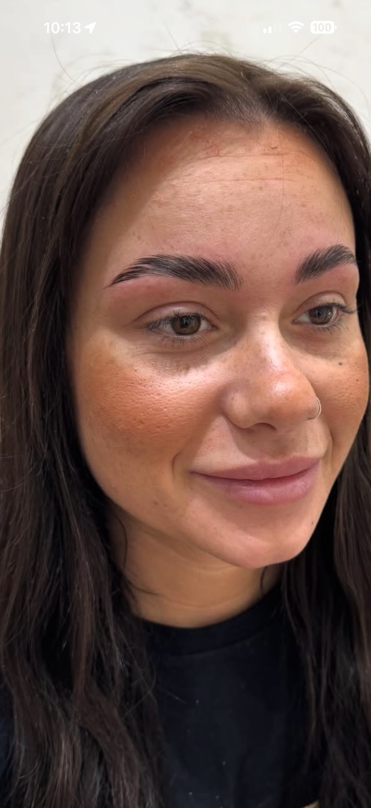 Brow Lift — αποτέλεσμα σε πρόσωπο