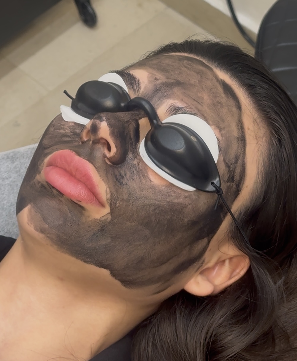 Carbon Peel