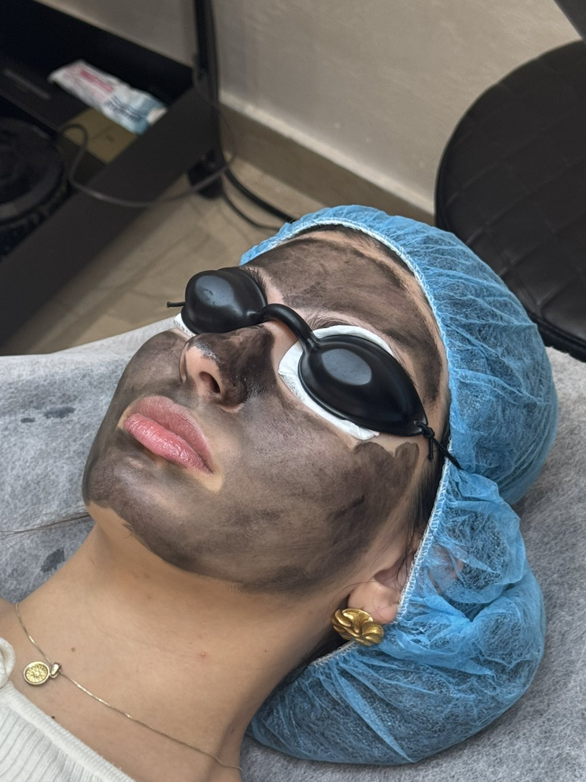 Carbon Peel — αποτέλεσμα θεραπείας carbon peel